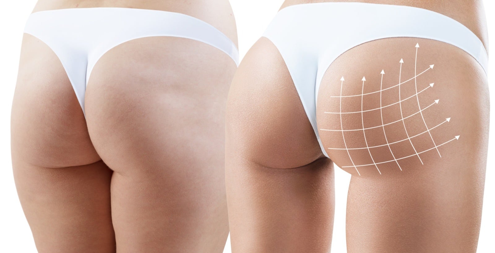 Brazilian buttlift